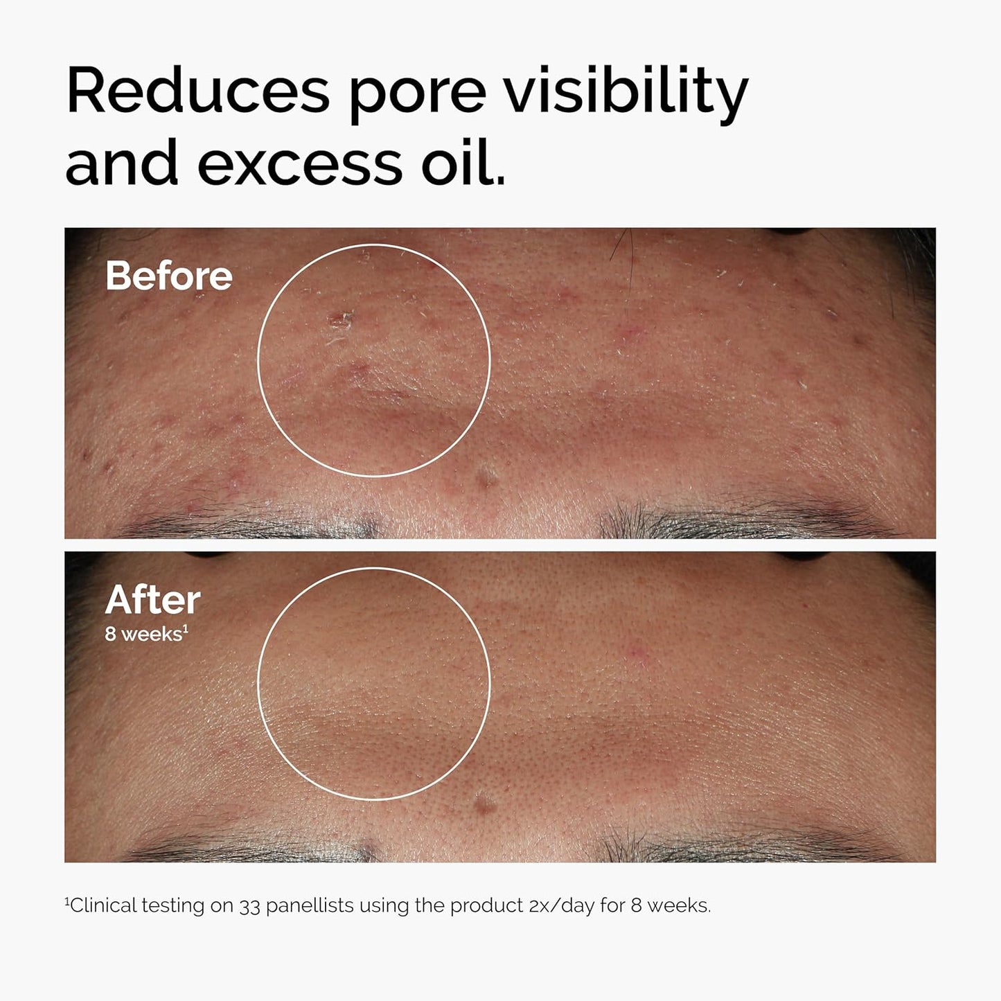 The Ordinary Niacinamide 10% + Zinc 1% Serum 30mL